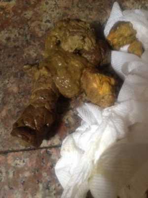 孕妇13周拉了好多屎,孕期拉的多正常么 第2张 孕妇13周拉了好多屎,孕期拉的多正常么 第2张