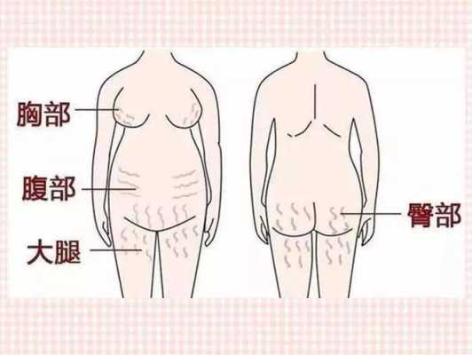 孕期肚子长纹(孕期肚子长纹怎么控制) 第3张 孕期肚子长纹(孕期肚子长纹怎么控制) 第3张