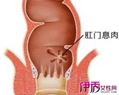 孕期痔疮肉球(孕妇怀孕期间肛门长了一个肉疙瘩,不痛也不痒是怎么回事) 第2张 孕期痔疮肉球(孕妇怀孕期间肛门长了一个肉疙瘩,不痛也不痒是怎么回事) 第2张