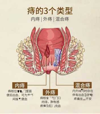 孕期痔疮肉球(孕妇怀孕期间肛门长了一个肉疙瘩,不痛也不痒是怎么回事) 第1张 孕期痔疮肉球(孕妇怀孕期间肛门长了一个肉疙瘩,不痛也不痒是怎么回事) 第1张