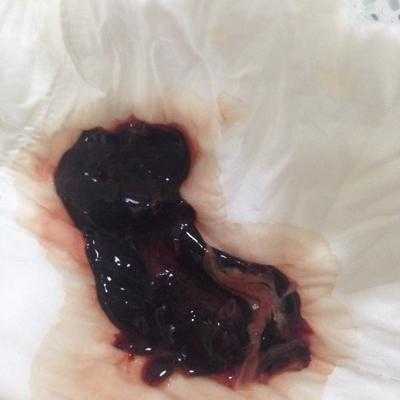 孕期出血有血块(孕期出血有血块孩子能保住吗) 第3张 孕期出血有血块(孕期出血有血块孩子能保住吗) 第3张