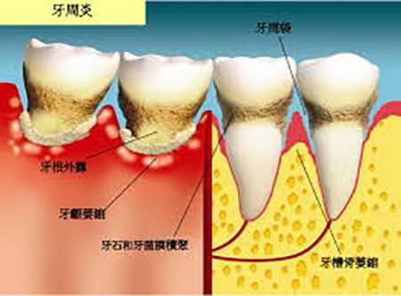 孕期牙周炎怎么治疗（孕期牙周炎怎么治疗）  第3张