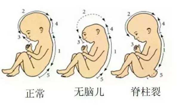 叶酸过多,会导致胎儿癫痫吗,胎儿羊癫疯的胎动特征 第2张 叶酸过多,会导致胎儿癫痫吗,胎儿羊癫疯的胎动特征 第2张