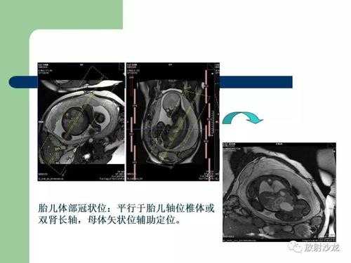 胎儿mr检查(MR成像技术分类) 第1张 胎儿mr检查(MR成像技术分类) 第1张