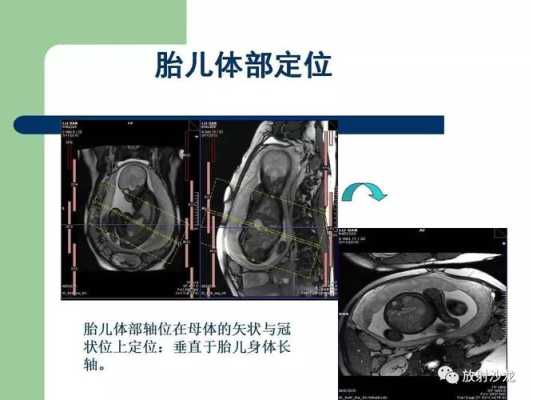 胎儿mr检查(MR成像技术分类) 第2张 胎儿mr检查(MR成像技术分类) 第2张