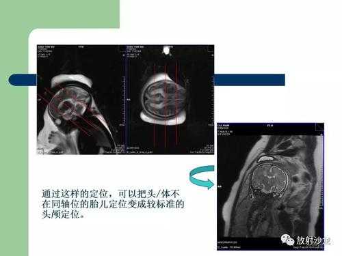 胎儿mr检查(MR成像技术分类) 第3张 胎儿mr检查(MR成像技术分类) 第3张