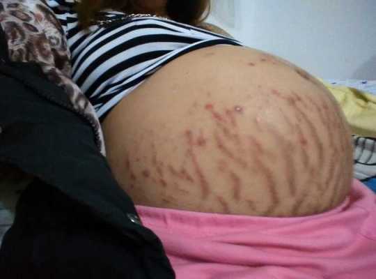 孕期长妊辰纹(孕期长妊辰纹怎么控制和消除) 第3张 孕期长妊辰纹(孕期长妊辰纹怎么控制和消除) 第3张