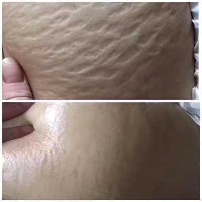 孕期长妊辰纹(孕期长妊辰纹怎么控制和消除) 第2张 孕期长妊辰纹(孕期长妊辰纹怎么控制和消除) 第2张