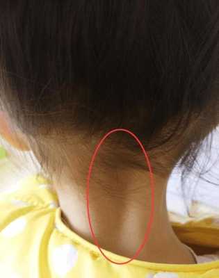 胎儿脖颈厚(胎儿脖颈厚) 第1张 胎儿脖颈厚(胎儿脖颈厚) 第1张