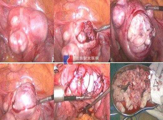 怀孕了宫腔粘连怎么办,不知道是重度还是轻度,孕期宫腔黏连带对胎儿有影响吗 第1张 怀孕了宫腔粘连怎么办,不知道是重度还是轻度,孕期宫腔黏连带对胎儿有影响吗 第1张