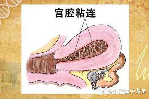 怀孕了宫腔粘连怎么办,不知道是重度还是轻度,孕期宫腔黏连带对胎儿有影响吗 第2张 怀孕了宫腔粘连怎么办,不知道是重度还是轻度,孕期宫腔黏连带对胎儿有影响吗 第2张