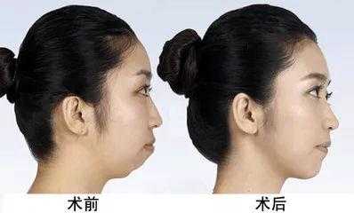 胎儿下巴短(下巴短怎么让下巴变长) 第2张 胎儿下巴短(下巴短怎么让下巴变长) 第2张