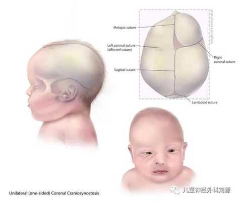 额缝是哪里,胎儿额缝早闭和基因有关系吗  第2张