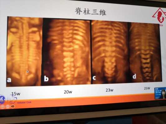 胎儿脊柱偏（胎儿脊柱位于母体右侧是什么意思）  第2张