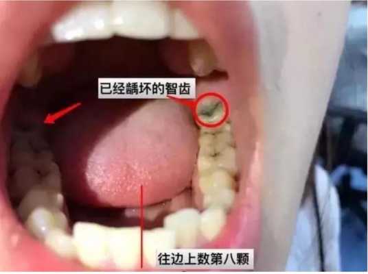 智齿痛对胎儿(智齿痛对胎儿有影响么?) 第2张 智齿痛对胎儿(智齿痛对胎儿有影响么?) 第2张