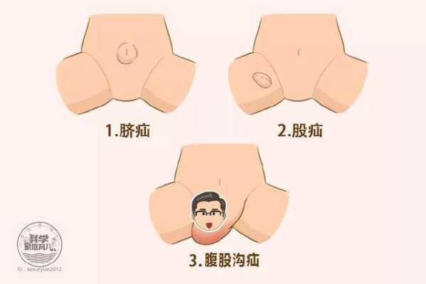 孕期疝气怎么办(疝气是怎么引起的孕妇) 第2张 孕期疝气怎么办(疝气是怎么引起的孕妇) 第2张