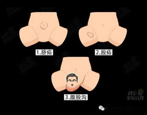 孕期疝气怎么办(疝气是怎么引起的孕妇) 第1张 孕期疝气怎么办(疝气是怎么引起的孕妇) 第1张