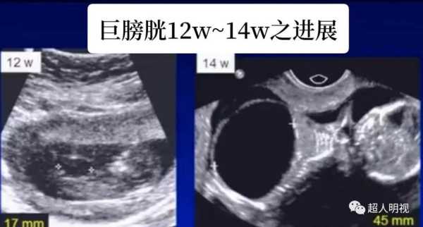 巨膀胱胎儿 原因（巨膀胱胎儿 原因）  第1张