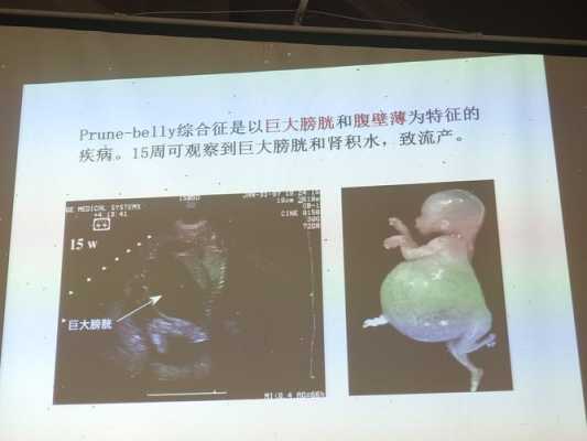 巨膀胱胎儿 原因（巨膀胱胎儿 原因）  第2张