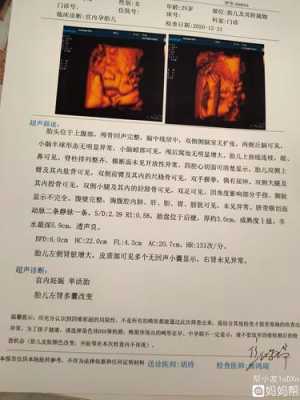 胎儿左肾没有(做四维显示胎儿左肾多发囊性无回声什么意思) 第1张 胎儿左肾没有(做四维显示胎儿左肾多发囊性无回声什么意思) 第1张