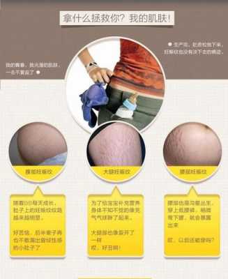 孕妇长妊娠纹了怎么办?有什么方法可以消除,孕期妊娠纹如何消除最快 第2张 孕妇长妊娠纹了怎么办?有什么方法可以消除,孕期妊娠纹如何消除最快 第2张