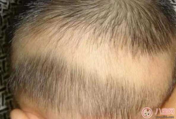 三个月宝宝会脱发吗,胎儿会掉头发吗 第1张 三个月宝宝会脱发吗,胎儿会掉头发吗 第1张