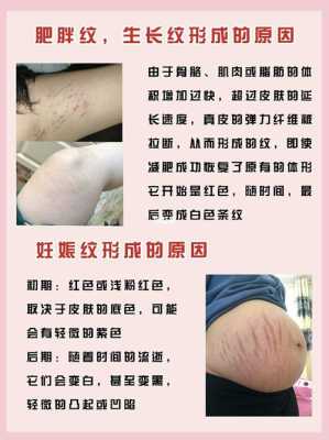 孕期妊娠纹如何去除(孕期妊娠纹如何去除图片) 第1张 孕期妊娠纹如何去除(孕期妊娠纹如何去除图片) 第1张