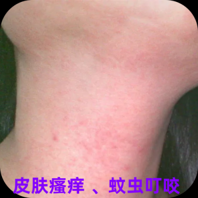 孕妇脖子痒痒一抓发红起一块红疙瘩是为什么？能擦什么药,孕期皮肤瘙痒用什么药膏  第2张