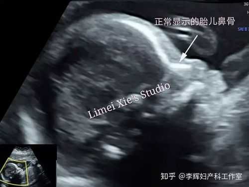 12周胎儿视频(12周胎儿鼻骨缺失是畸形吗) 第2张 12周胎儿视频(12周胎儿鼻骨缺失是畸形吗) 第2张