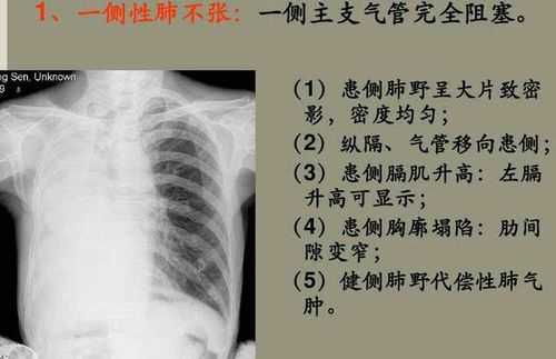 胎儿肺不张(胎儿肺不张) 第2张 胎儿肺不张(胎儿肺不张) 第2张
