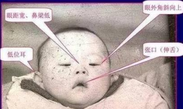 胎儿眼距小(胎儿眼距小有什么危害) 第1张 胎儿眼距小(胎儿眼距小有什么危害) 第1张