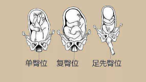 胎儿一直臀位什么原因,胎儿臀位原因造成的 第3张 胎儿一直臀位什么原因,胎儿臀位原因造成的 第3张