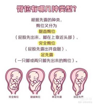 胎儿一直臀位什么原因,胎儿臀位原因造成的 第1张 胎儿一直臀位什么原因,胎儿臀位原因造成的 第1张