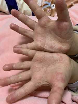 孕期手脚湿疹怎么办（孕期手脚湿疹怎么办啊）  第2张