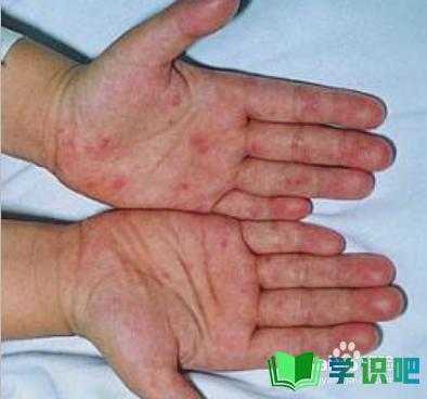 孕期手脚湿疹怎么办（孕期手脚湿疹怎么办啊）  第1张