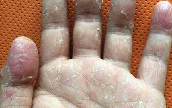 孕妇脸脱皮怎么回事,孕期手脱皮怎么回事儿 第2张 孕妇脸脱皮怎么回事,孕期手脱皮怎么回事儿 第2张