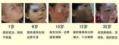 胎儿脸上胎记怎么预防(胎儿脸上胎记怎么预防遗传) 第2张 胎儿脸上胎记怎么预防(胎儿脸上胎记怎么预防遗传) 第2张