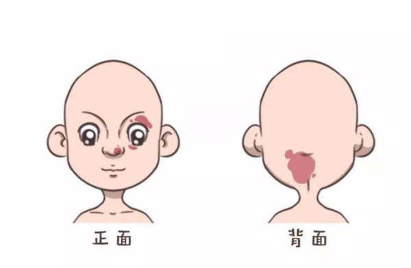 胎儿脸上胎记怎么预防(胎儿脸上胎记怎么预防遗传) 第1张 胎儿脸上胎记怎么预防(胎儿脸上胎记怎么预防遗传) 第1张