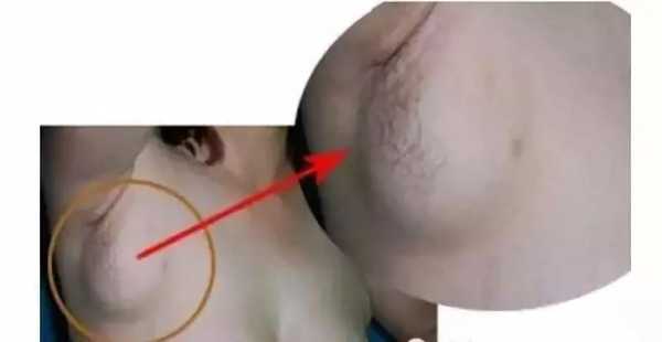 孕妇腋下淋巴结肿大怎么办,孕期腋窝淋巴结肿大怎么回事  第1张