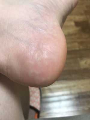 孕期脚很痒怎么办,孕期脚热怎么办快速缓解 第2张 孕期脚很痒怎么办,孕期脚热怎么办快速缓解 第2张
