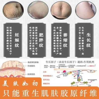 如何去肚子的妊娠纹,孕妇妊辰纹怎么去除 第1张 如何去肚子的妊娠纹,孕妇妊辰纹怎么去除 第1张
