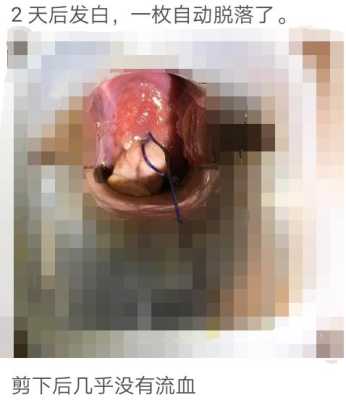 孕期宫颈息肉怎么办(孕期宫颈息肉怎么办?) 第3张 孕期宫颈息肉怎么办(孕期宫颈息肉怎么办?) 第3张