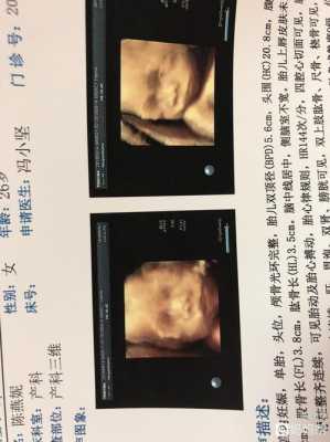 长鼻子男孩短片解析,胎儿三维鼻子好大 第1张 长鼻子男孩短片解析,胎儿三维鼻子好大 第1张