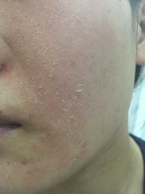 产妇脸上起皮干痒怎么办,孕期脸很干怎么办 第1张 产妇脸上起皮干痒怎么办,孕期脸很干怎么办 第1张