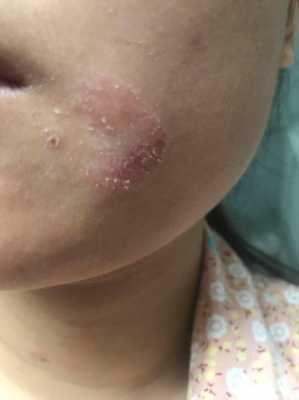 产妇脸上起皮干痒怎么办,孕期脸很干怎么办 第2张 产妇脸上起皮干痒怎么办,孕期脸很干怎么办 第2张