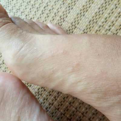 孕期脚痒起小水泡(孕妇手上起水泡很痒对胎儿有影响吗) 第2张 孕期脚痒起小水泡(孕妇手上起水泡很痒对胎儿有影响吗) 第2张