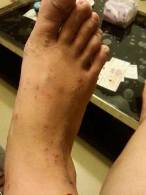 孕妇脚上会有湿疹是怎么回事,孕期脚上湿疹怎么办啊 第3张 孕妇脚上会有湿疹是怎么回事,孕期脚上湿疹怎么办啊 第3张