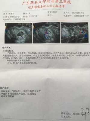 血流信号是胎儿的什么(血流信号是胎儿的什么部位) 第3张 血流信号是胎儿的什么(血流信号是胎儿的什么部位) 第3张