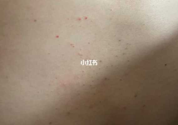 孕妇得湿疹怎么办,孕期出现湿疹怎么办啊 第3张 孕妇得湿疹怎么办,孕期出现湿疹怎么办啊 第3张