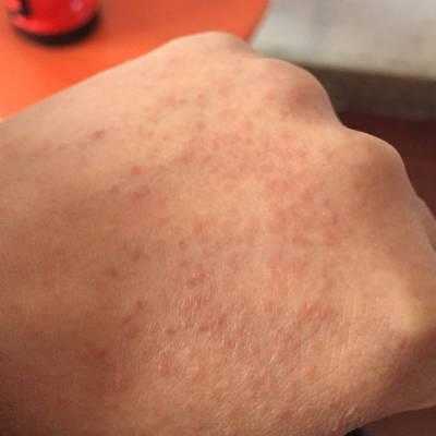 孕期手长湿疹怎么办(孕妇长湿疹怎么办) 第1张 孕期手长湿疹怎么办(孕妇长湿疹怎么办) 第1张